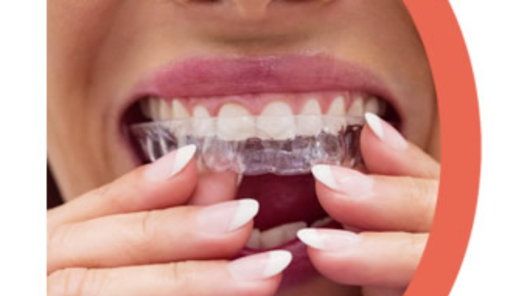 Invisalign